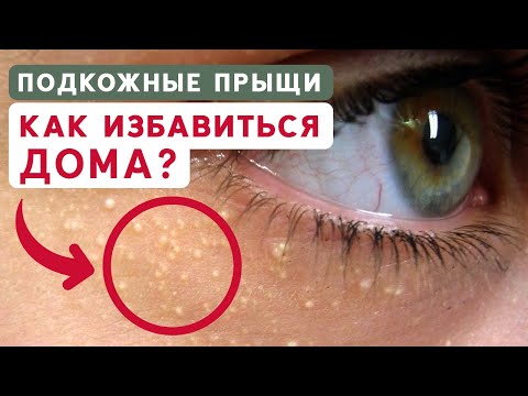 Чем опасны ПОДКОЖНЫЕ ПРЫЩИ? / Как избавиться от прыщей в домашних условиях?  - YouTube