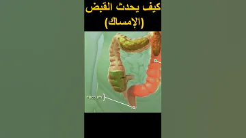 كيف يحدث القبض أو الإمساك امساك قبض صحة صحة وتغذية بطن علاج طب مرض معدة Constipation 