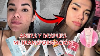 MANCHAS ANTES Y DESPUES| COMO QUITE LAS MANCHAS Y MARCAS DE ACNÉ| TRANSFORMACIÓN DE LA PIEL⭐️