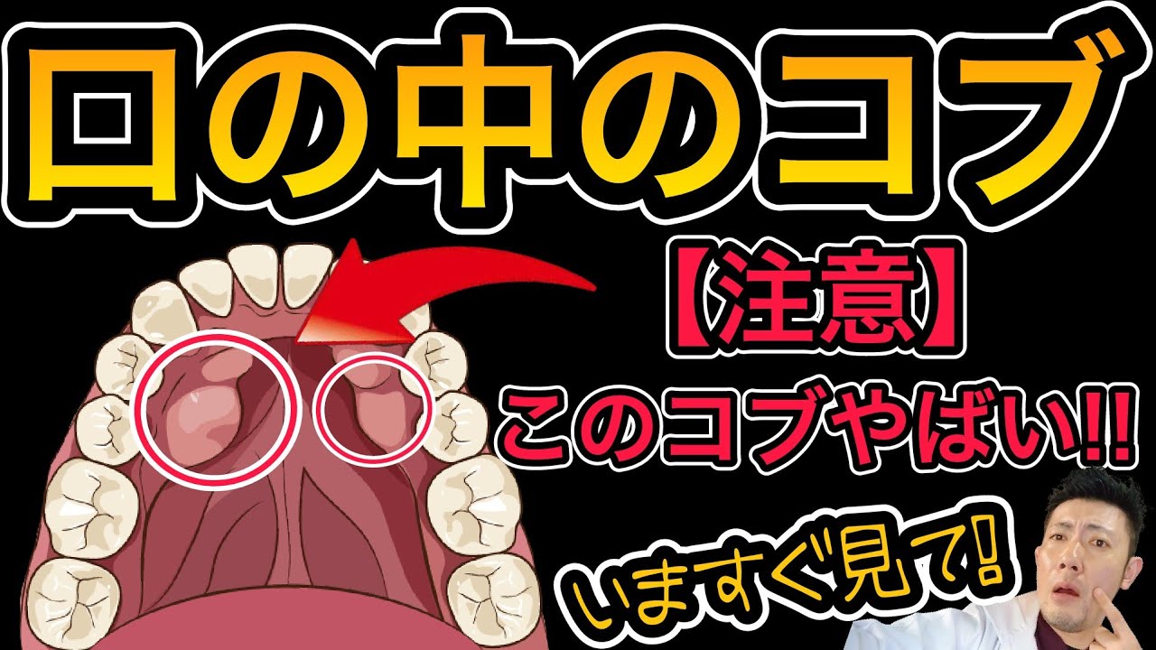【注意】口の中のコブ注意してください!手術も必要かも!?歯茎のコブ・骨隆起 - YouTube