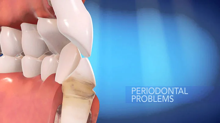 Invisalign BenefitsMOV
