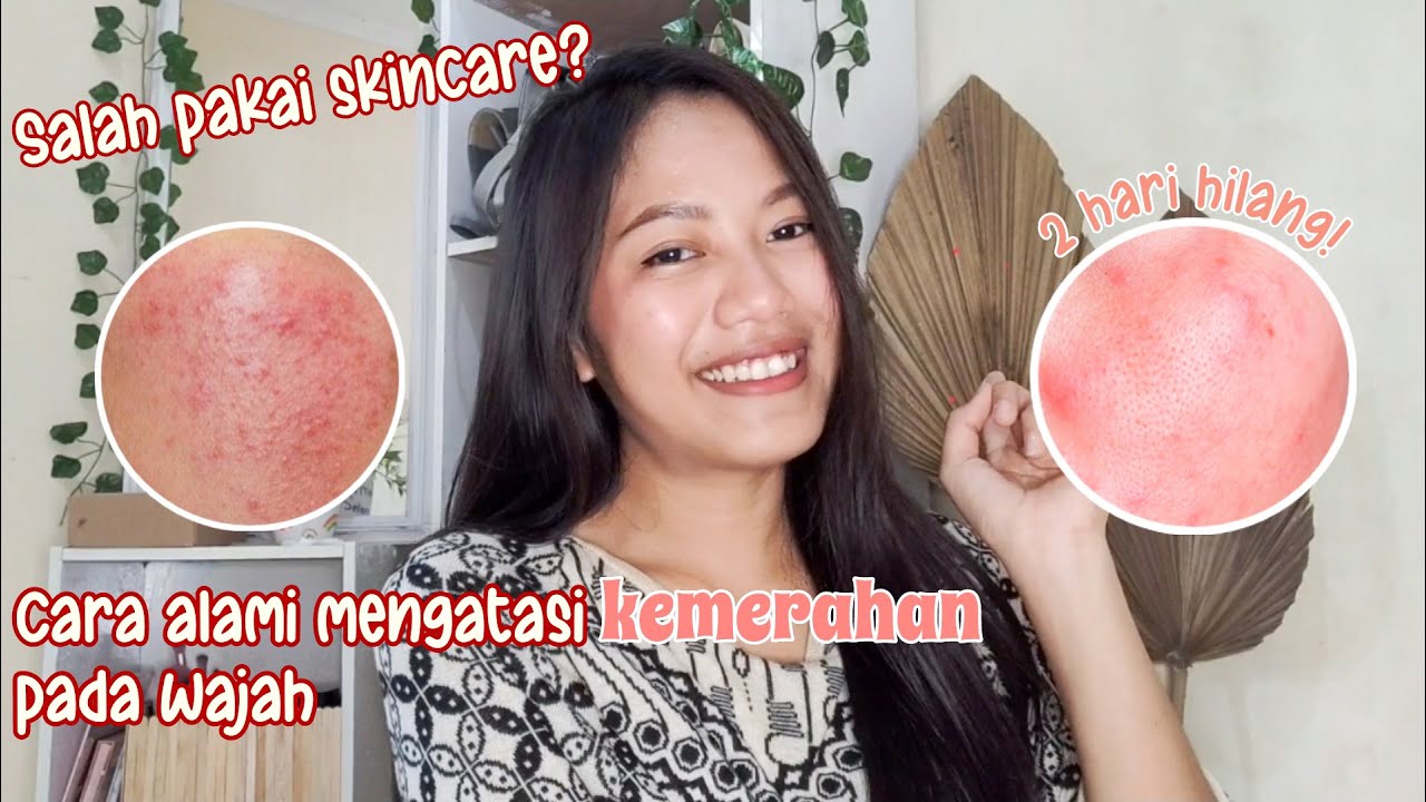 CARA ALAMI MENGHILANGKAN KEMERAHAN AKIBAT SALAH KAPAI SKINCARE - YouTube