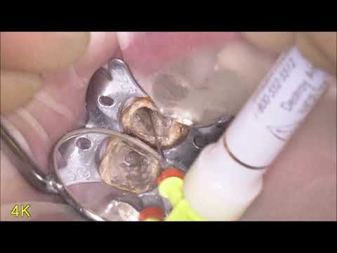 サイナストラクトのある根管治療　Opelaser Filio