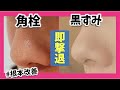 【毛穴黒ずみ撃退法】即効で効く！角質角栓除去！【いちご鼻・黒ずみ・角栓改善】