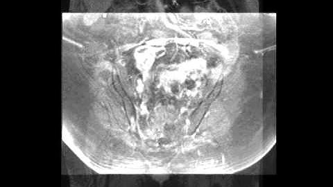 Acute diverticulitis