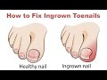 How to Fix Ingrown Toenails At Home