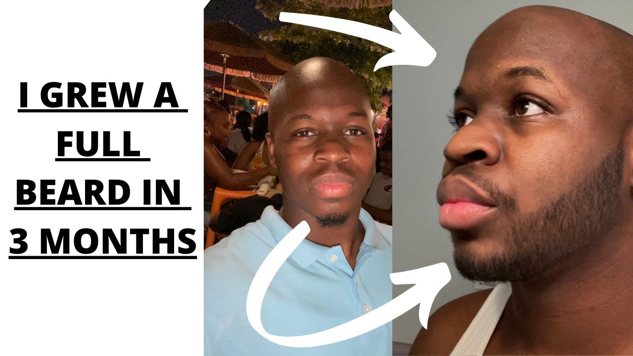 I Grew A Full Beard In 3 Months! ( Minoxidil Beard Journey )