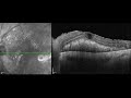 Vitrectomy in sub retinal haemorrhagedense vh case