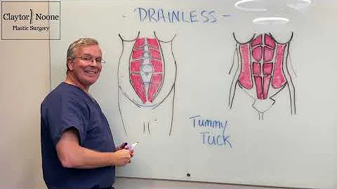 Drainless tummy tuck with explanation of how it is done by Dr. Claytor