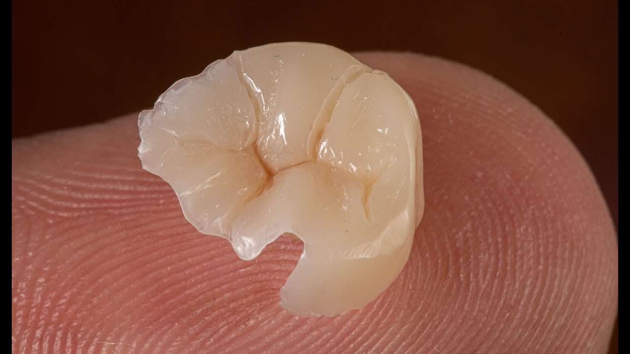 Resina compuesta indirecta- Die silicon