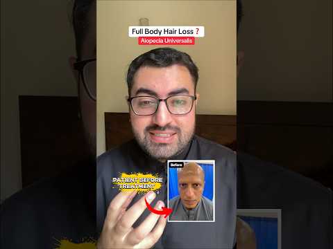 Full Body HairLoss ❓ Alopecia Universalis ✅
