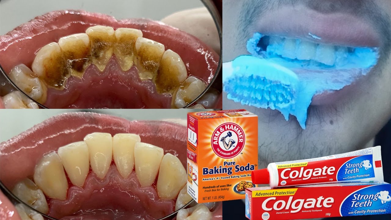 Magical Natural Ways to Whiten Teeth at Home only 5 minutes - YouTube
