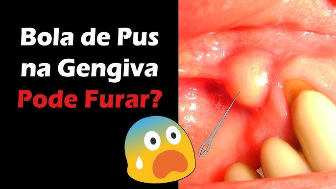 É normal ter um caroço no céu da boca? - Blog Dentalclean