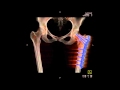 МСКТ тазобедренного сустава
