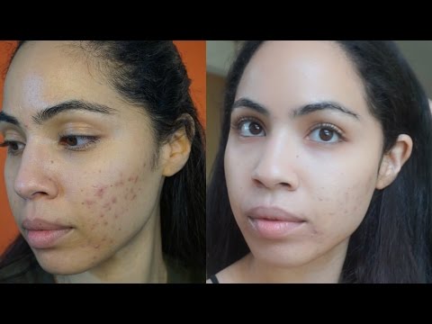 Acne Update - Clearing My Skin With Food