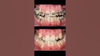 Braces 😀