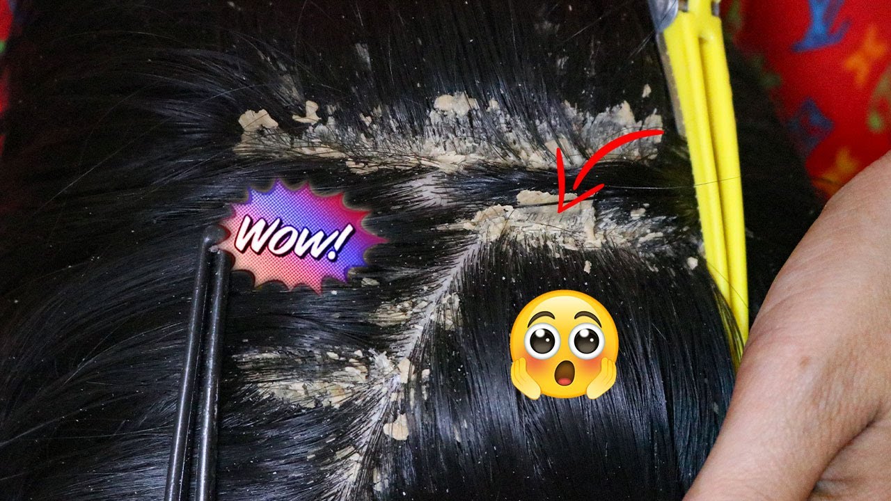 Wow to remove dandruff black hair 49 YouTube