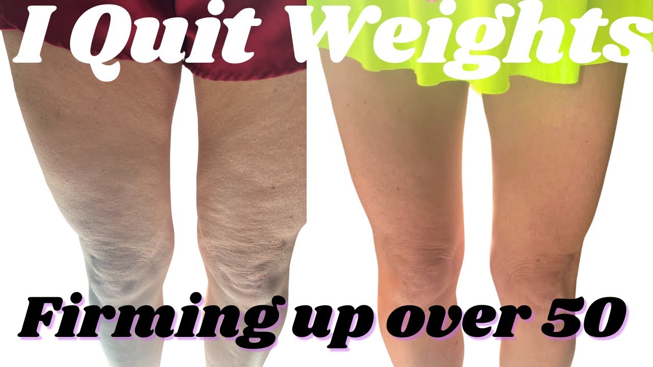 Will Cellulite Go Away With Weight Loss: Discover the Truth