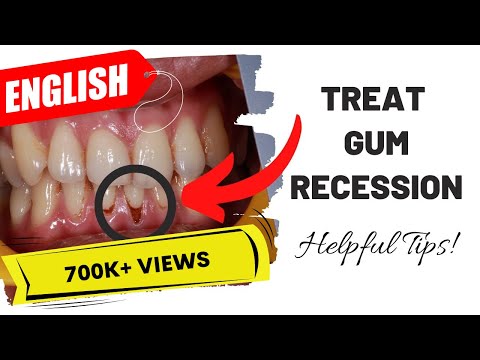 Minimize Gum Recession at Home