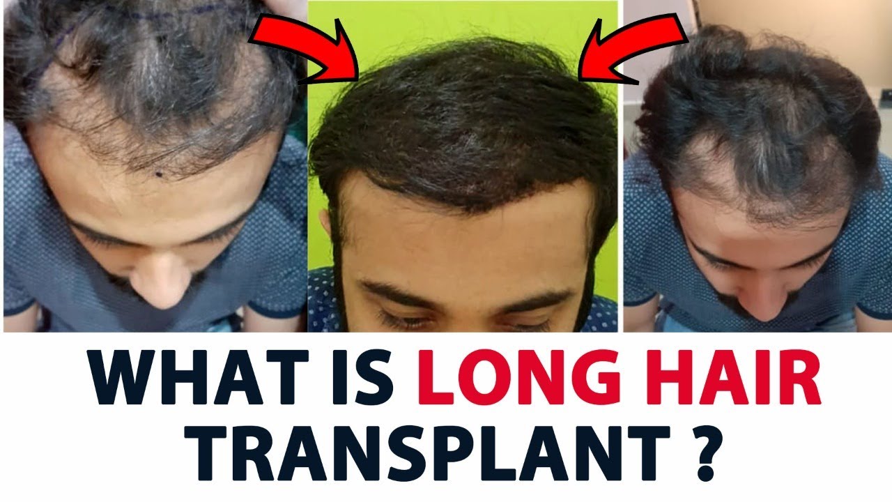 Best Long Hair Transplant in Delhi | Cost | Benefits | Procedure