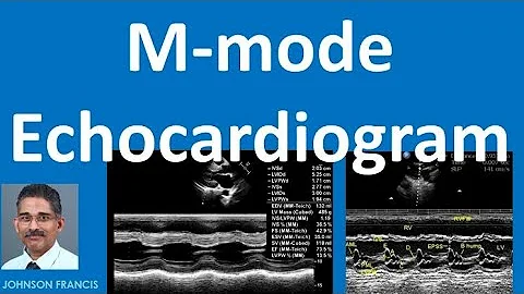 M-mode Echocardiogram