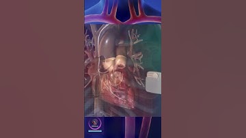 How a Pacemaker Works #shorts #education