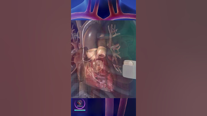 How a Pacemaker Works #shorts #education