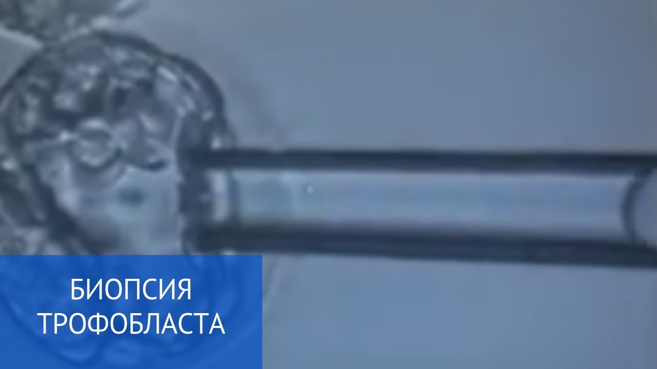 Биопсия трофобласта - выявление возможных генетических заболеваний у эмбриона