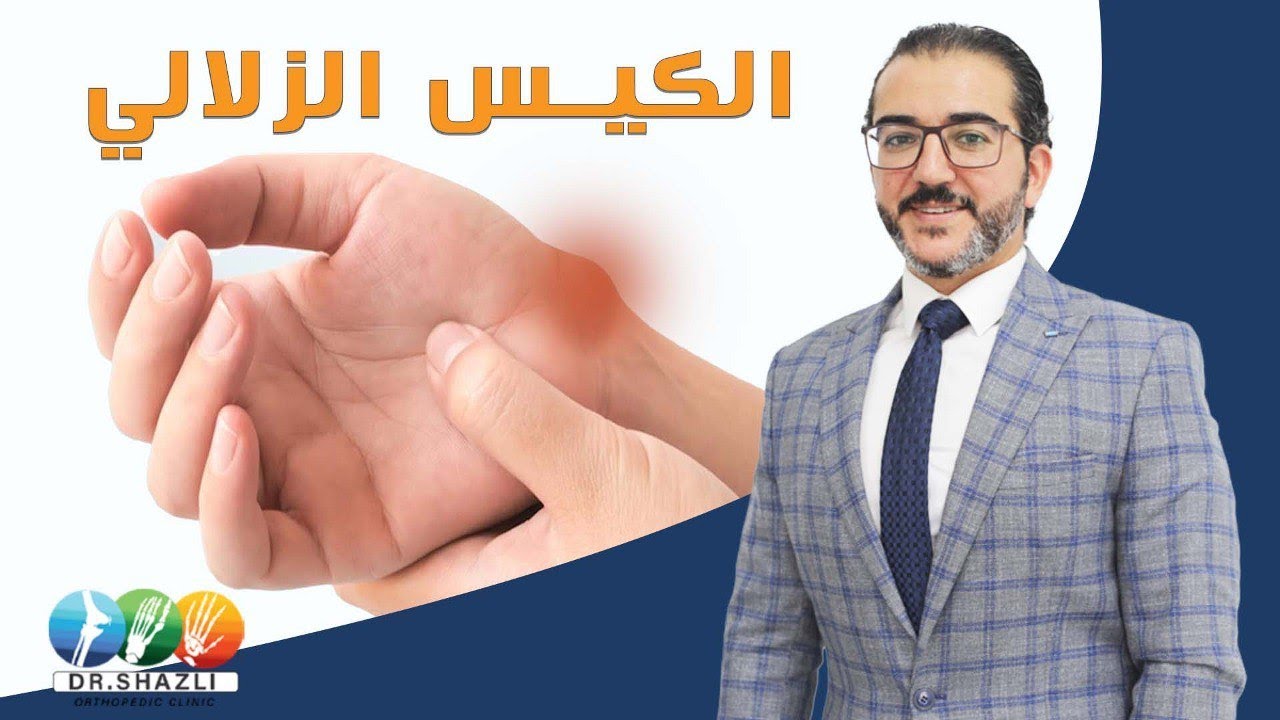 الكيس الزلالي | دكتور أحمد الشاذلي - إستشاري جراحة العظام