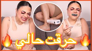 جربت ازالة الشعر بالحلاوة و حرقت حالي 😰 | شوفوا شو صار معي