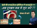 how to keep teeth clean after dental cleaning | danto ki safai