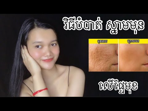 វិធីបំបាត់ស្នាម មុនលើផ្ទៃមុខ-How to clean your acne?/thychenghouy