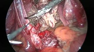 Histeroskopi Diagnostik Laparoskopi Operatif Part 2 - Kista Endometriosis