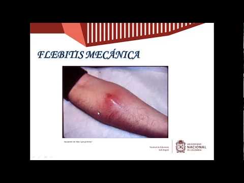 Video: Flebitis - Flebitis Po Injiciranju