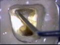 Endodontics  access cavity in tooth with metal ceramic crown