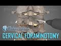 Cervical Foraminotomy