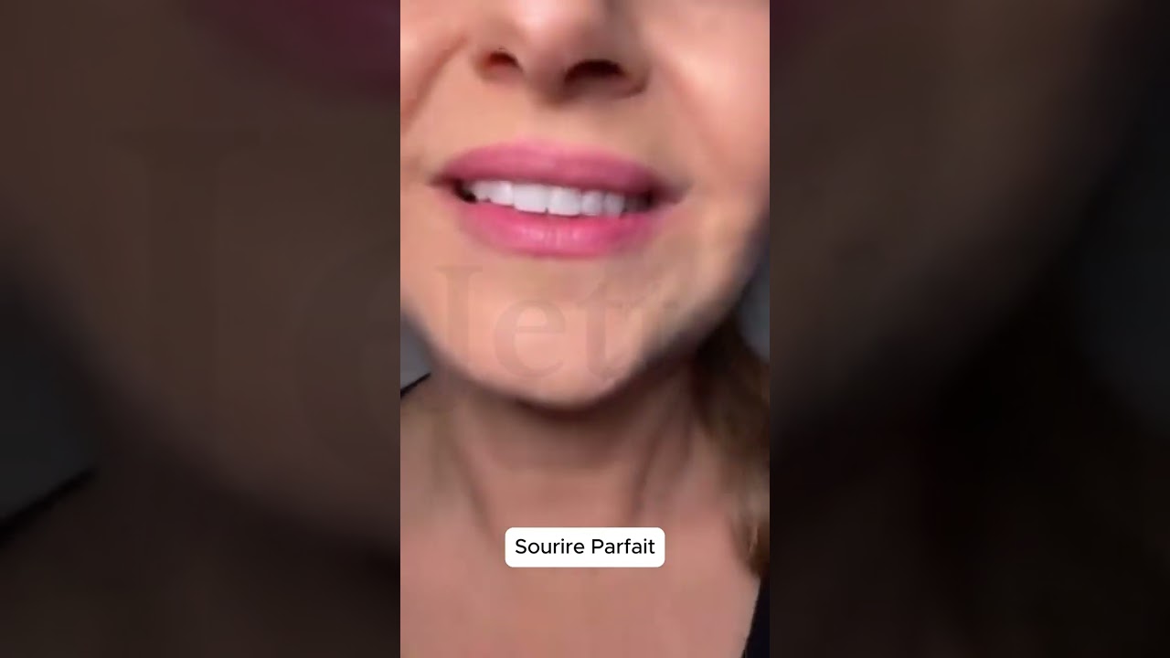 Sourire Parfait – Facettes Dentaires Inférieures et Supérieures pour un Sourire Éblouissant