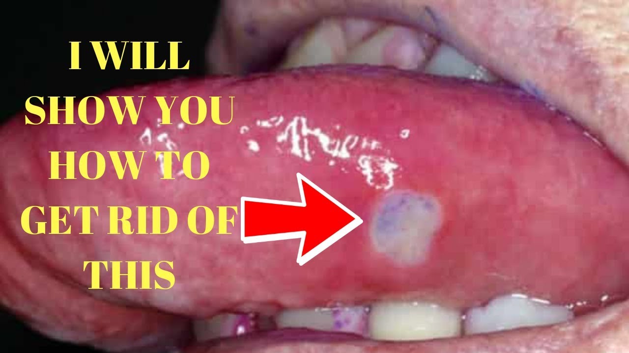 How To Get Rid Of Canker Sores On Tongue Canker Sores In Mouth Treatment Youtube