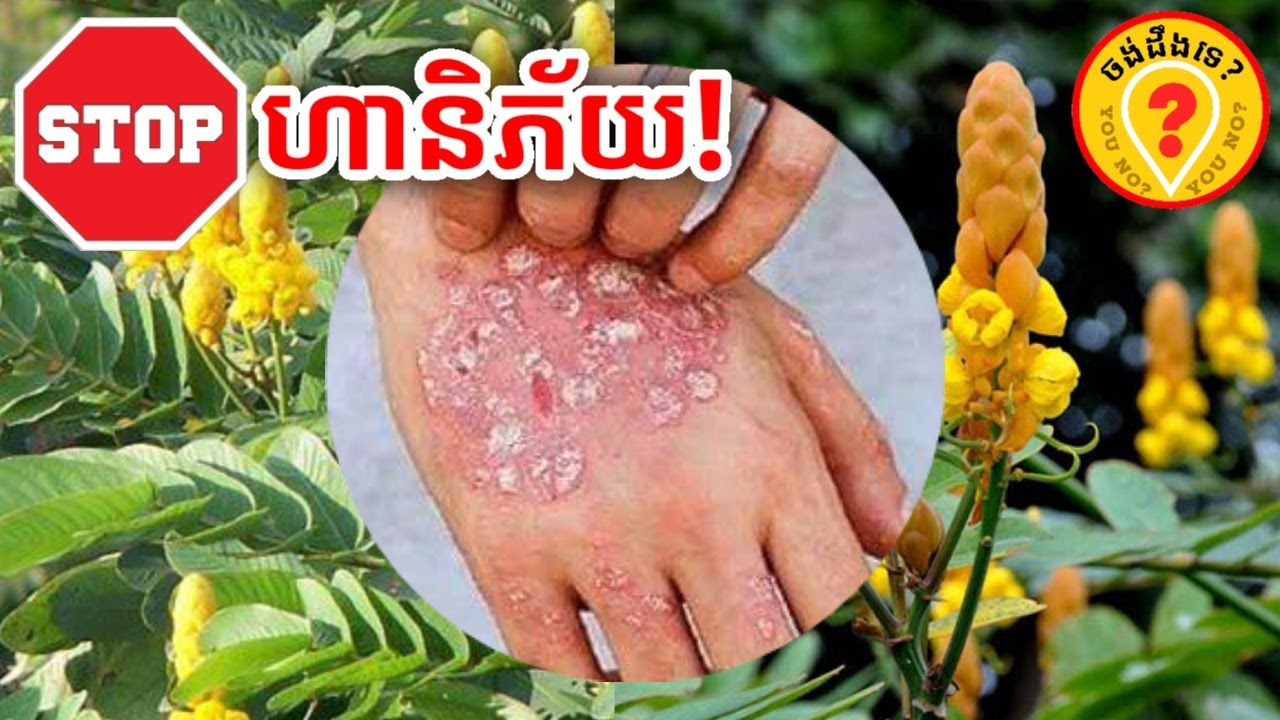 Amazing health benefits of Senna alata ស្លឹកដង្ហិតជាថ្នាំពូកែសក្តិសិទ្ធិ 2K