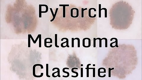 PyTorch Melanoma Classifier 2: Downloading/Processing Data