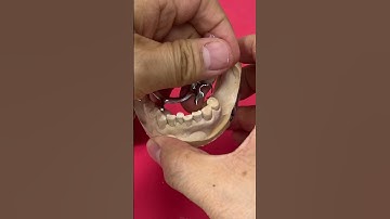 No more CoCr Partials thanks to Titanium Partials! #shorts #shortvideo #short #teeth #dental