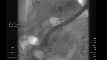 Mechanical lithotripsy for large bile duct stones using the Exalt single-use duodenoscope