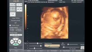 Gravimagem 19175 Ultrom Morfológico 3D 4D Em Gravidez Com 24 Semanas