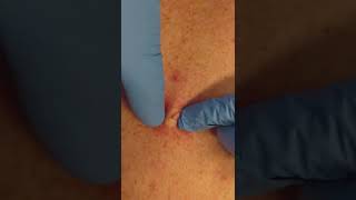 Sebaceous cyst extraction by a dermatologist shorts pimplepopping | CONTOUR DERMATOLOGY