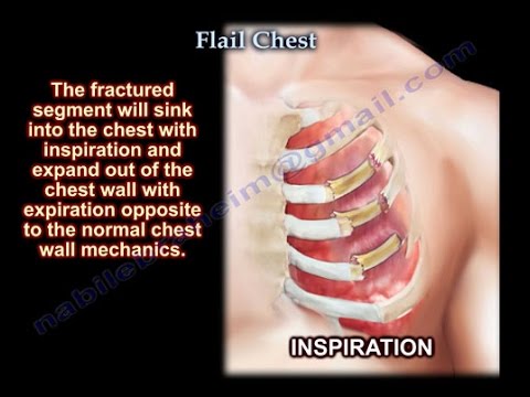 Video: Flail Chest: Behandling, Symtom Och återhämtning