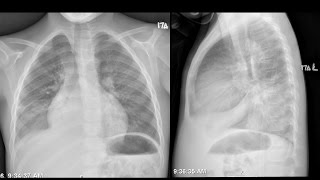 12 Y.o. Boy With Hemoglobin Ss, Fever, Cough, Chest Pain And Dyspnea