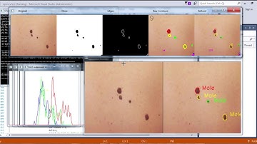 OpenCV experiment : using computer vision to diagnose skin diseases