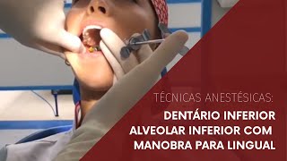 Técnica anestésica: Dentário Inferior/ Alveolar Inferior com manobra para lingual.
