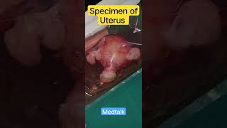 Specimen of Uterus |Hysterectomy mbbs shorts medical