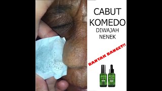 CABUT KOMEDO PALING SATISFYING!! Review Breylee Blackhead Mask - WA 082123226608